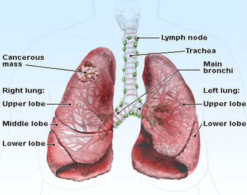 Ung thư phổi có chữa được không