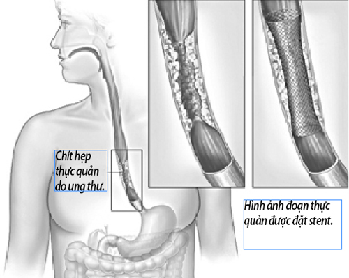 Phương pháp đặt stent cho người ung thư thực quản giai đoạn cuối
